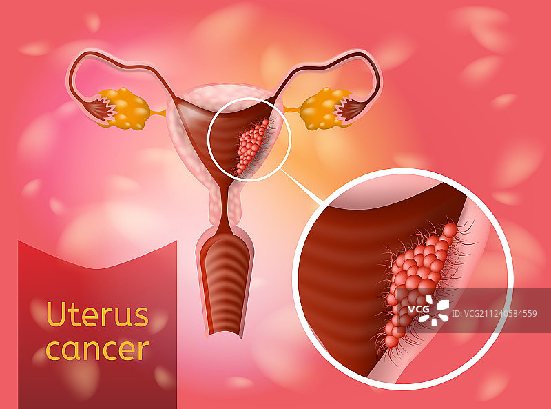 子宫癌现实的保健理念图片素材