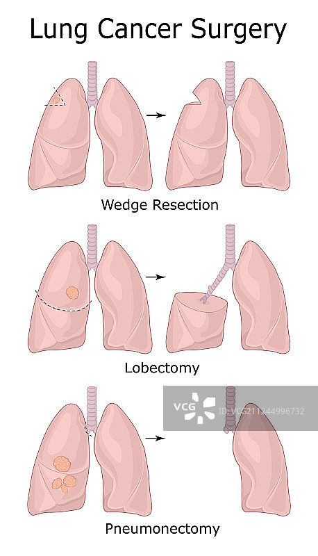 肺癌手术图片素材