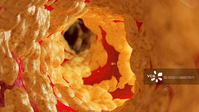 动脉内脂肪的图解图片素材