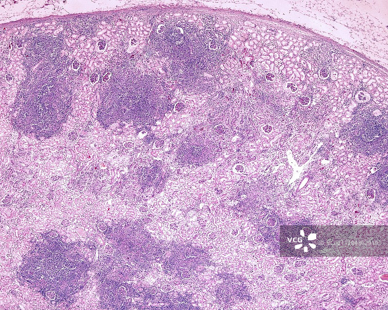 慢性肾盂肾炎，光学显微镜图片素材