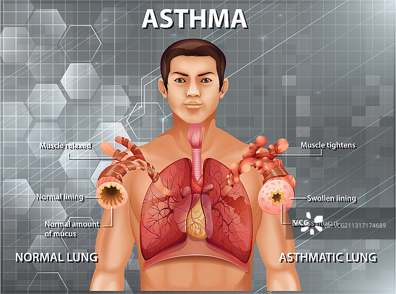 健康肺和哮喘肺的比较图片素材