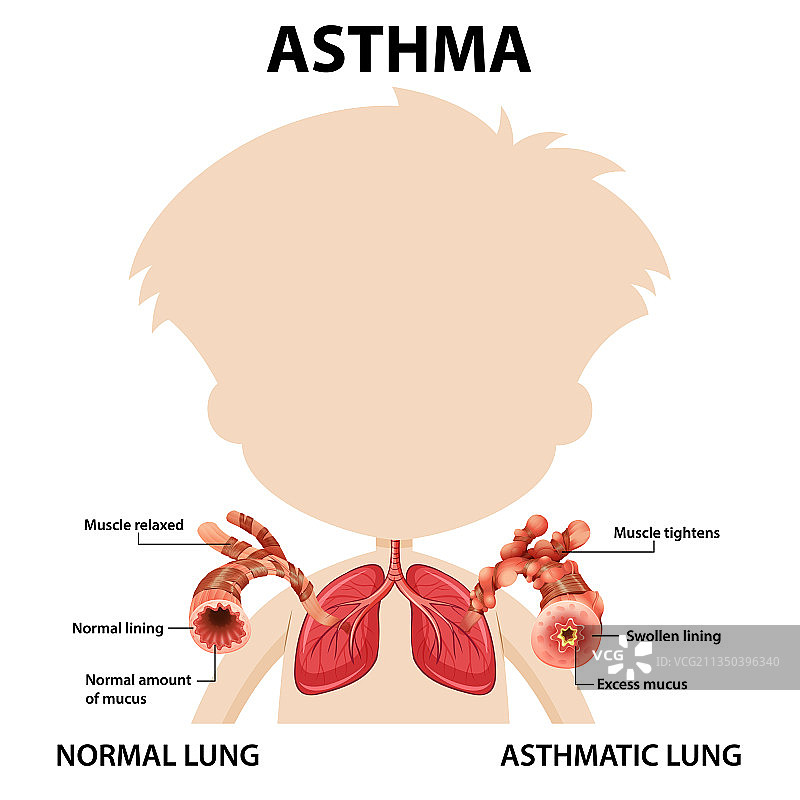 支气管哮喘图，肺正常图片素材