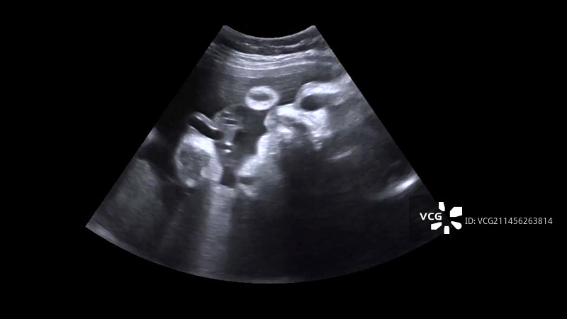 胎儿面部，超声波扫描图片素材