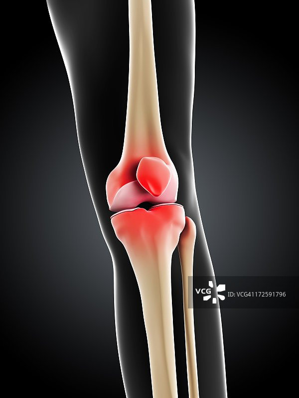 膝盖疼痛，概念艺术品图片素材