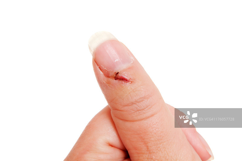 第6天白人女性拇指损伤系列图片素材