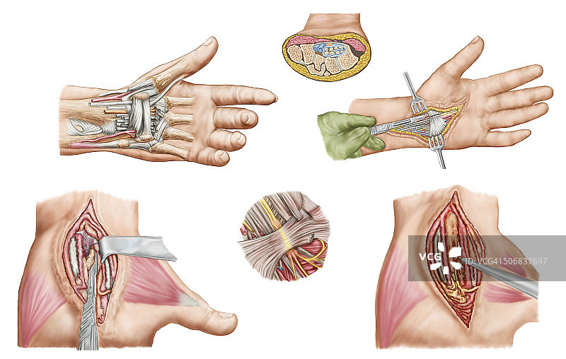 显示人类腕部腕管综合征的医学插图，以及与之相关的外科手术。图片素材
