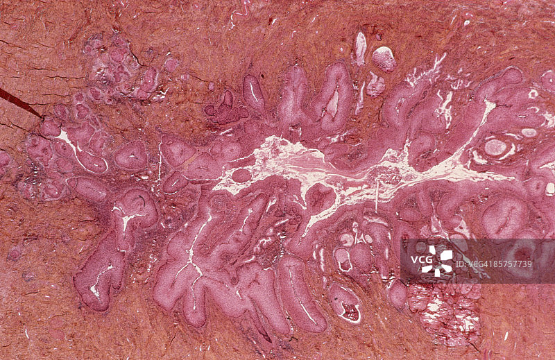 子宫颈癌图片素材