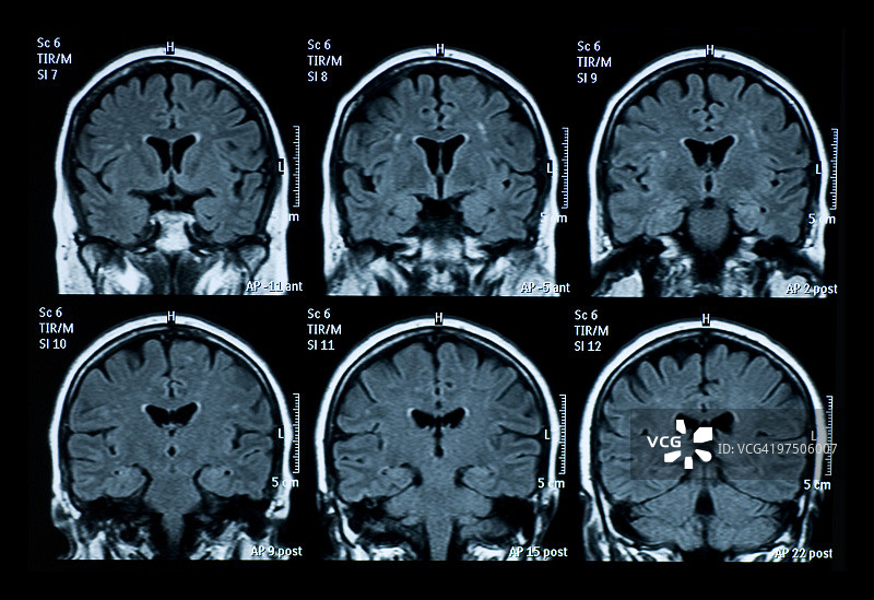 脑MRI扫描图片素材