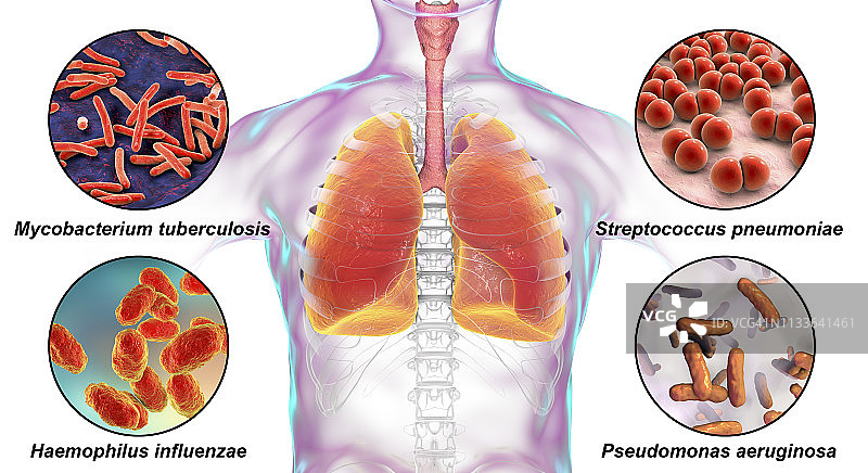 导致肺部感染的细菌，说明图片素材