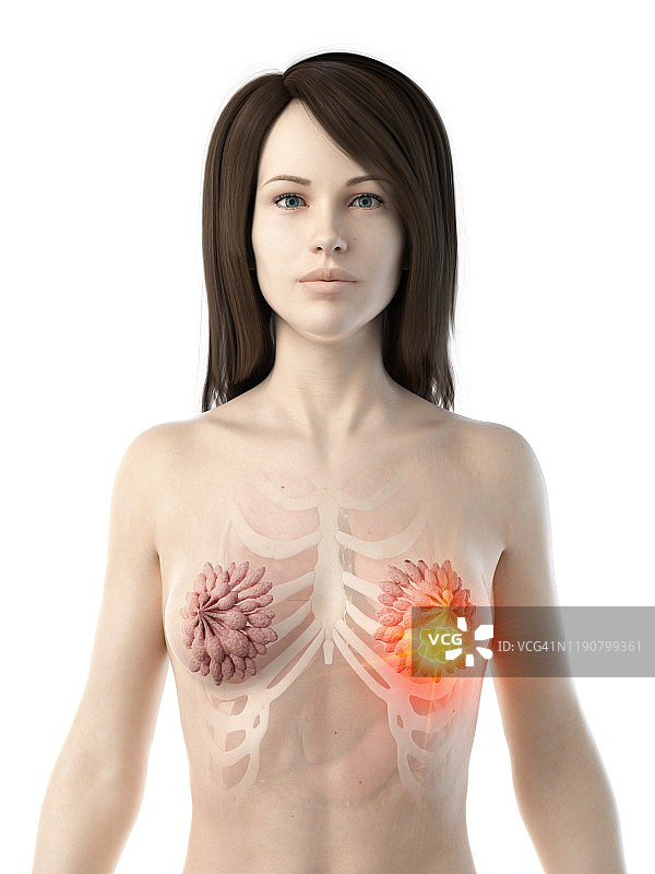 乳腺癌，概念插图图片素材