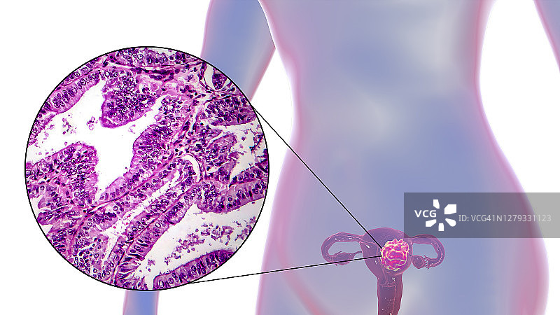 子宫癌，插图和光显微镜图片素材