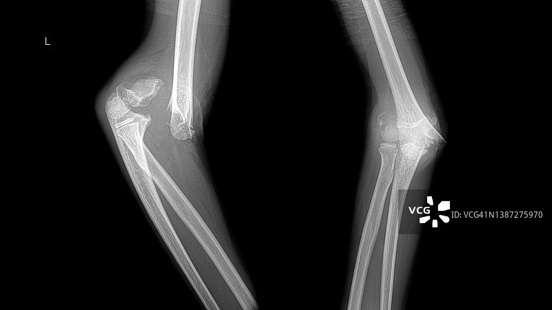小儿肘部肱骨骨折的x线照片。图片素材