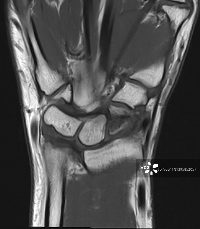 舟状骨腰部骨折MRI, T1冠状位延迟愈合图片素材