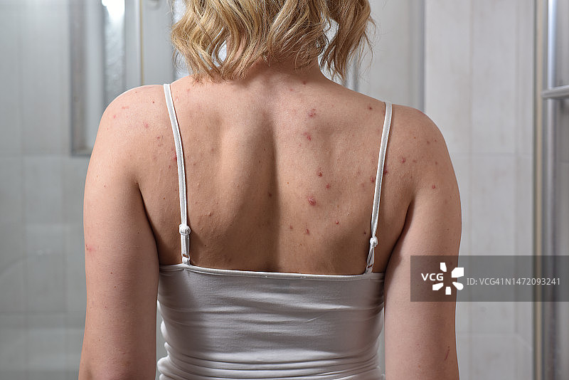 女性背部皮肤有痤疮图片素材