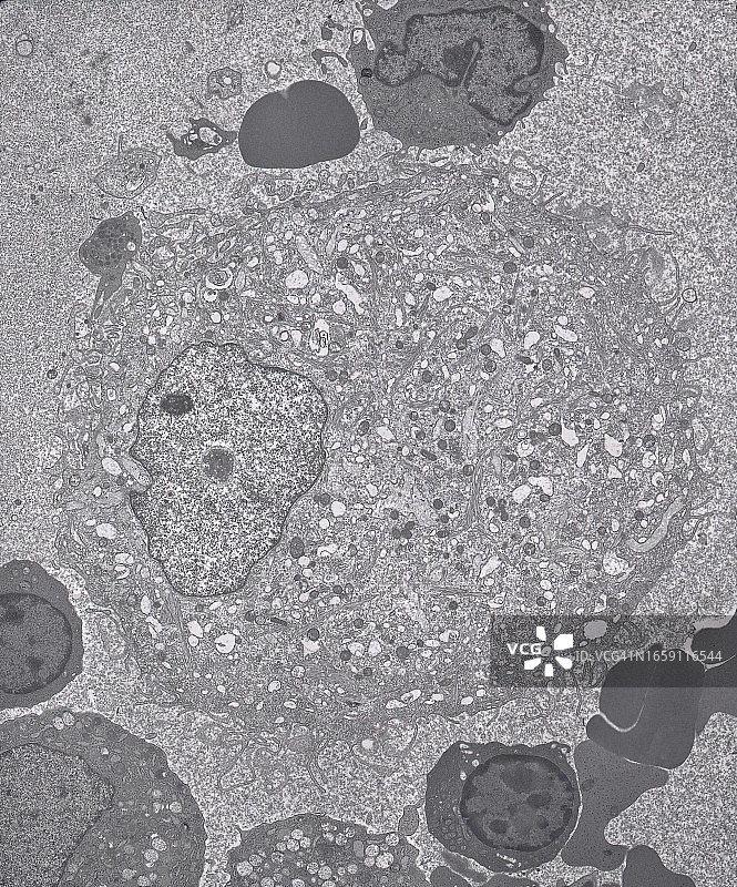 用透射电子显微镜对戈谢病患者血液中的戈谢氏细胞进行了观察图片素材
