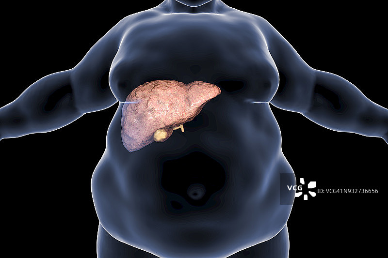 肥胖者脂肪肝的概念说明图片素材