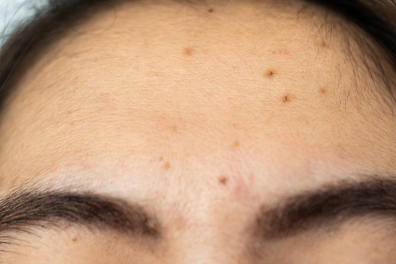 女人额头的问题与痤疮和疤痕的问题(丘疹和脓疱)在她的额头。图片下载