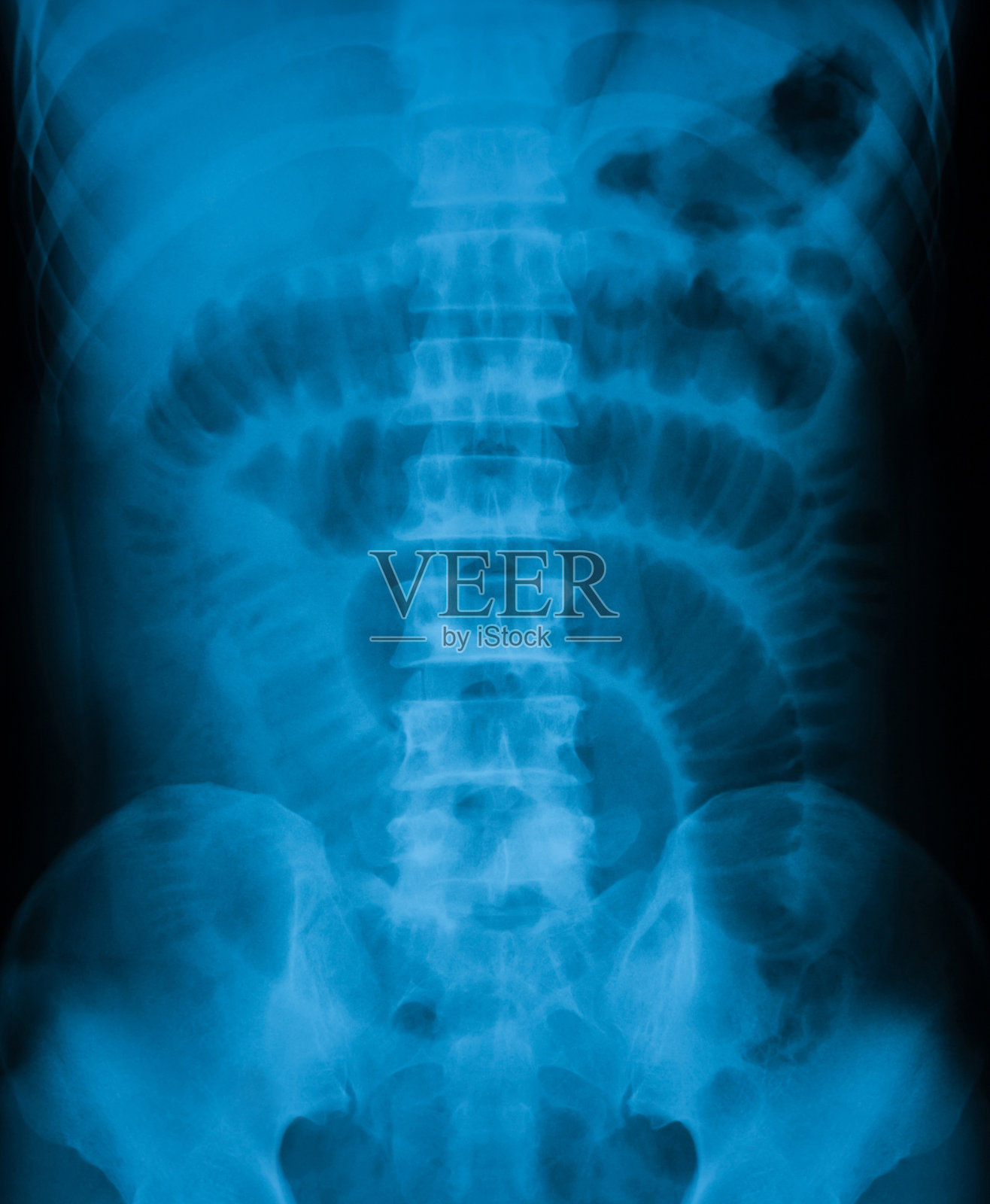 腹部疼痛的x线照片，显示小肠梗阻照片摄影图片