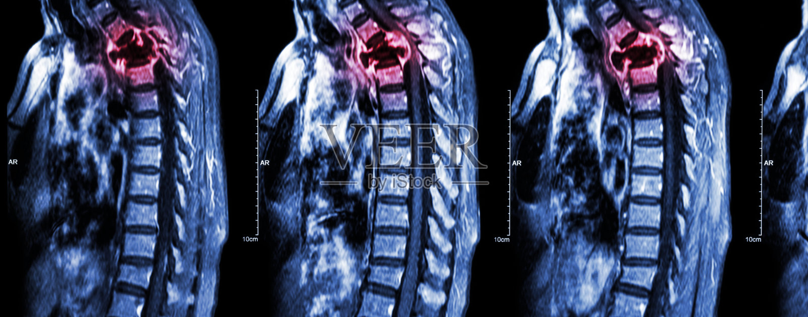 脊柱转移(癌症扩散至胸椎)照片摄影图片