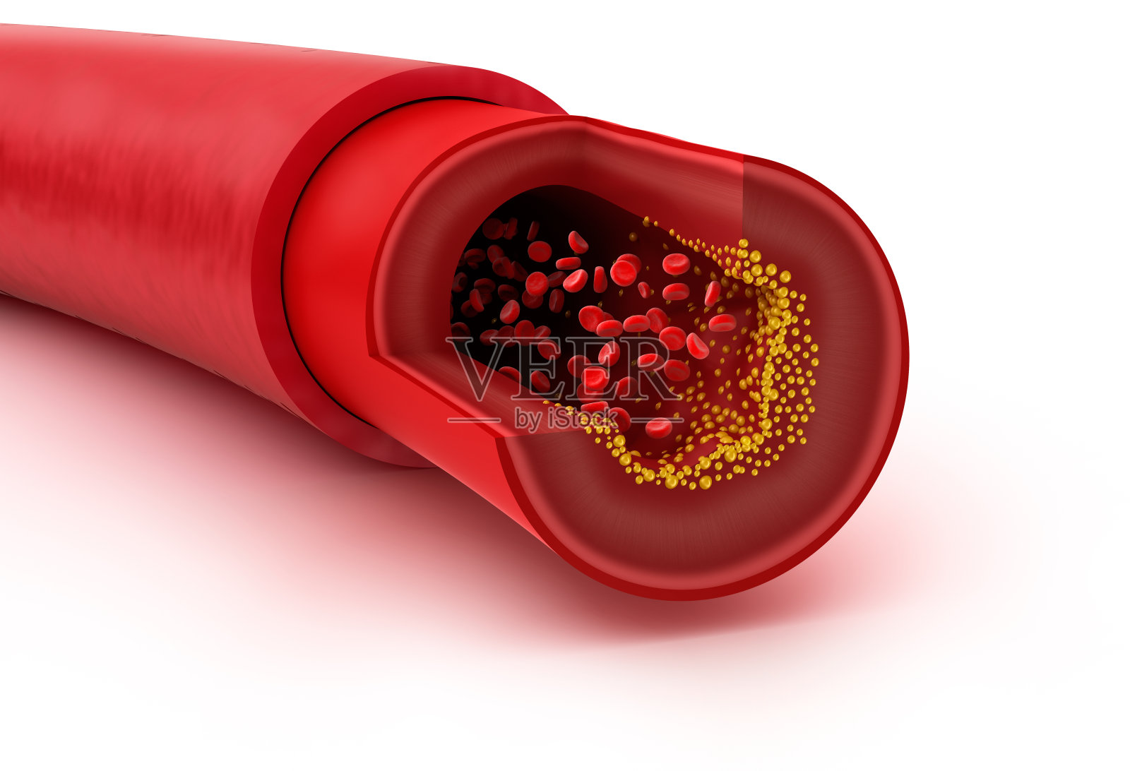 血管中的胆固醇斑块，3D插图照片摄影图片
