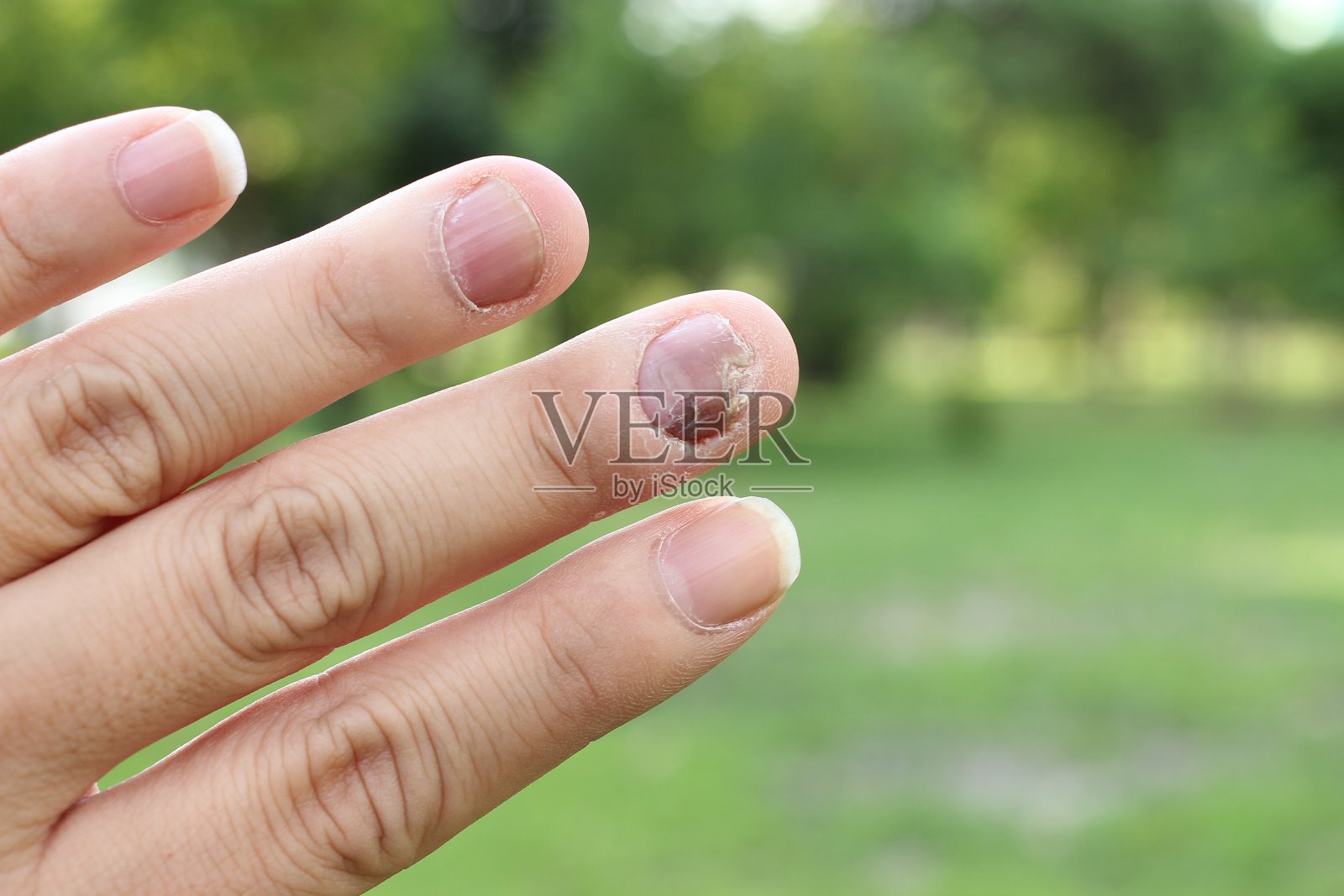 手指与甲真菌病。脚趾甲真菌。——软焦点照片摄影图片