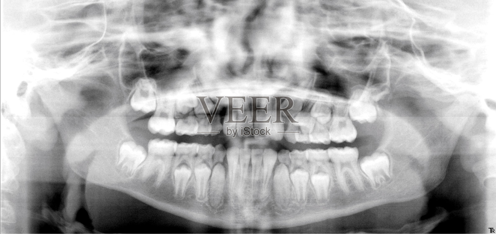 儿童颌部x光片显示发育中的牙齿照片摄影图片