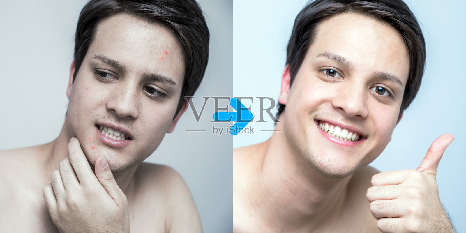 男士青春痘治疗前后形象，青春痘治疗，男士皮肤护理照片摄影图片
