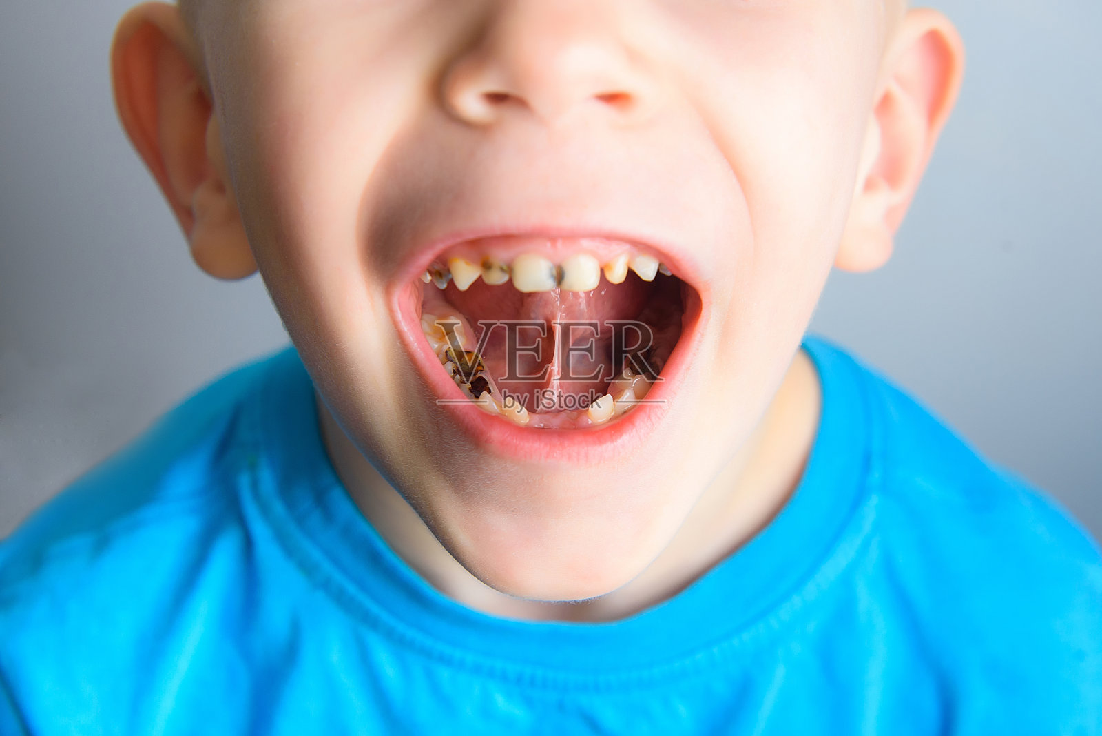 小孩牙齿上的蛀牙照片摄影图片