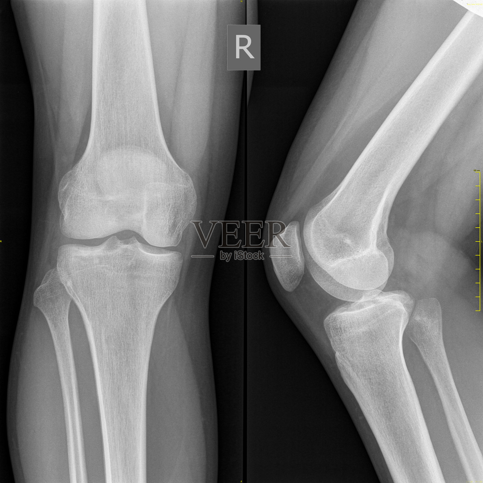 医用x光正常膝骨，高解析度影像照片摄影图片