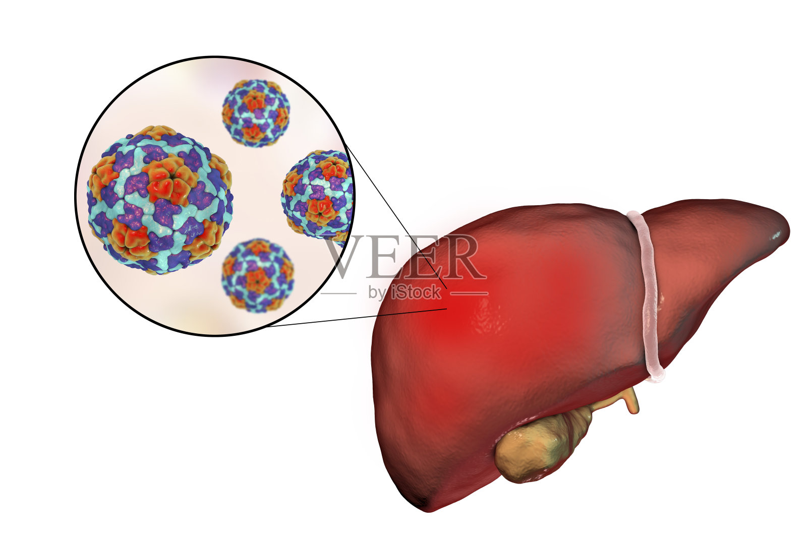 甲型肝炎感染的肝脏和甲型肝炎病毒的近距离观察照片摄影图片