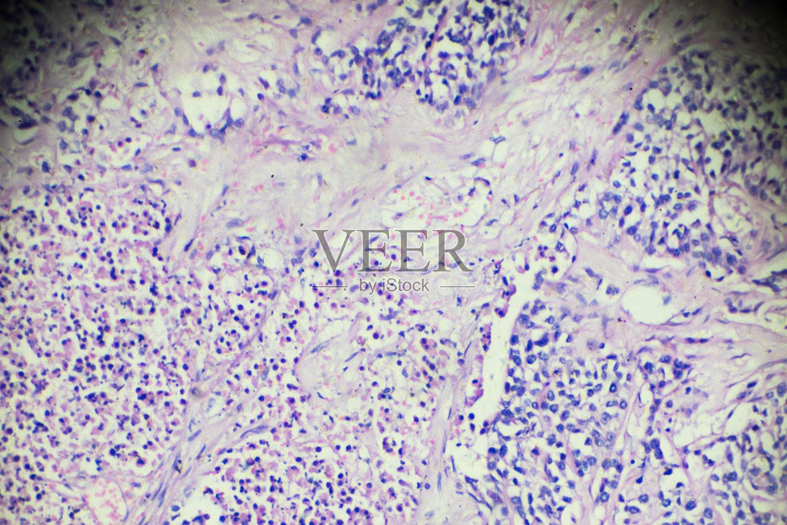 膀胱移行细胞癌的显微镜观察照片摄影图片