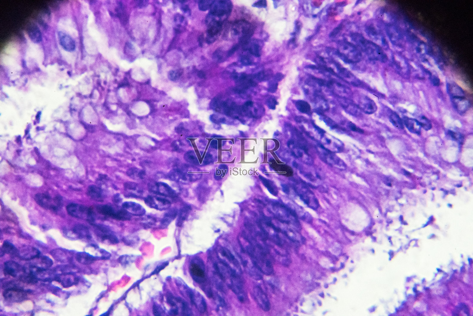 显微镜下的大肠癌(差异很大，管状腺癌)照片摄影图片