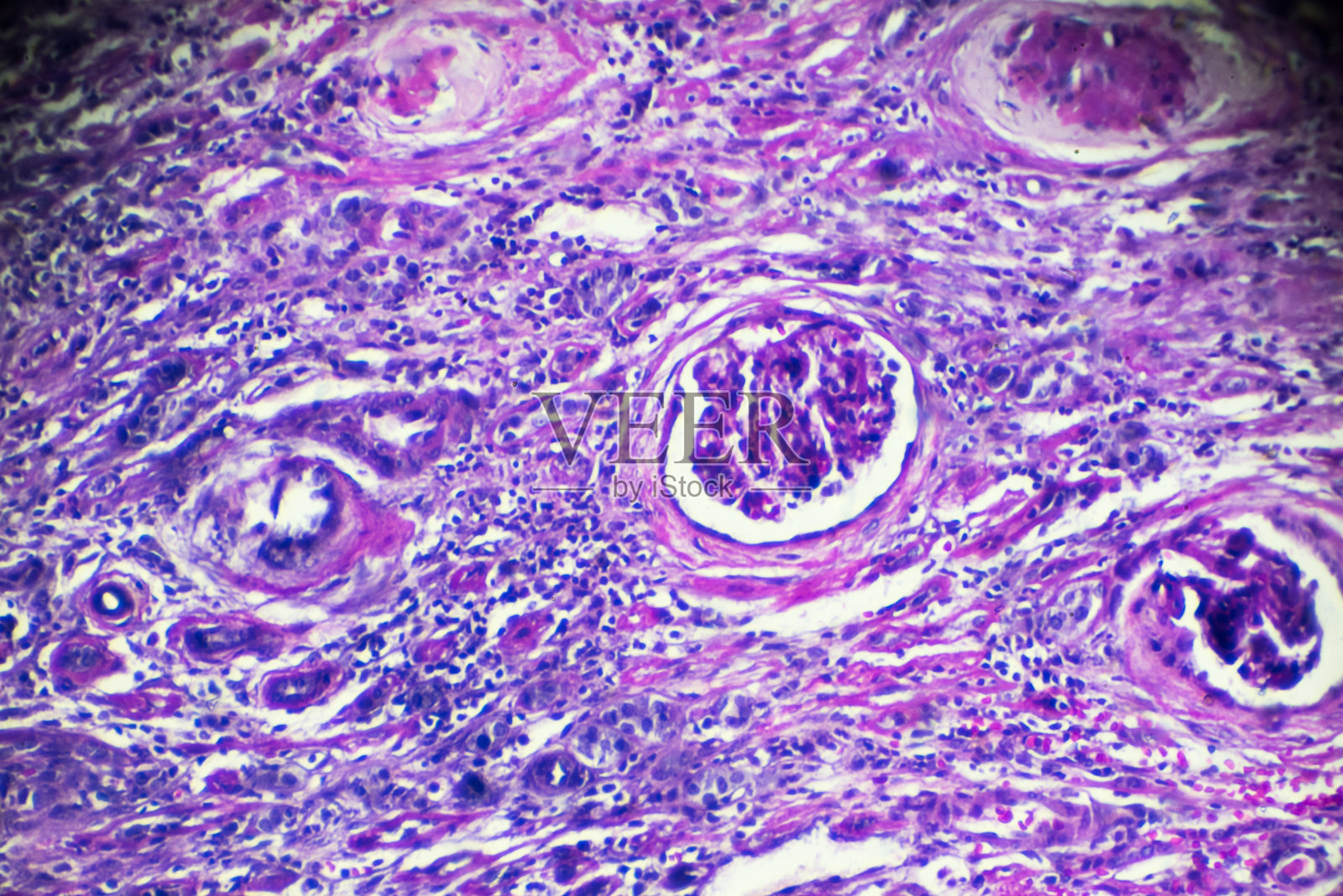 新月体肾小球肾炎活检标本照片摄影图片