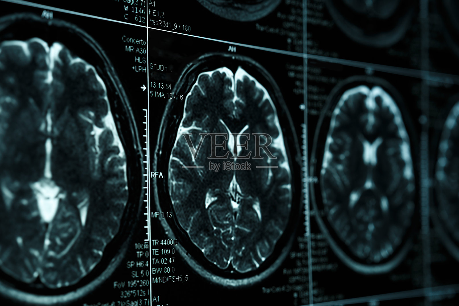 MRI或核磁共振图像的头部和大脑扫描。关闭视图照片摄影图片