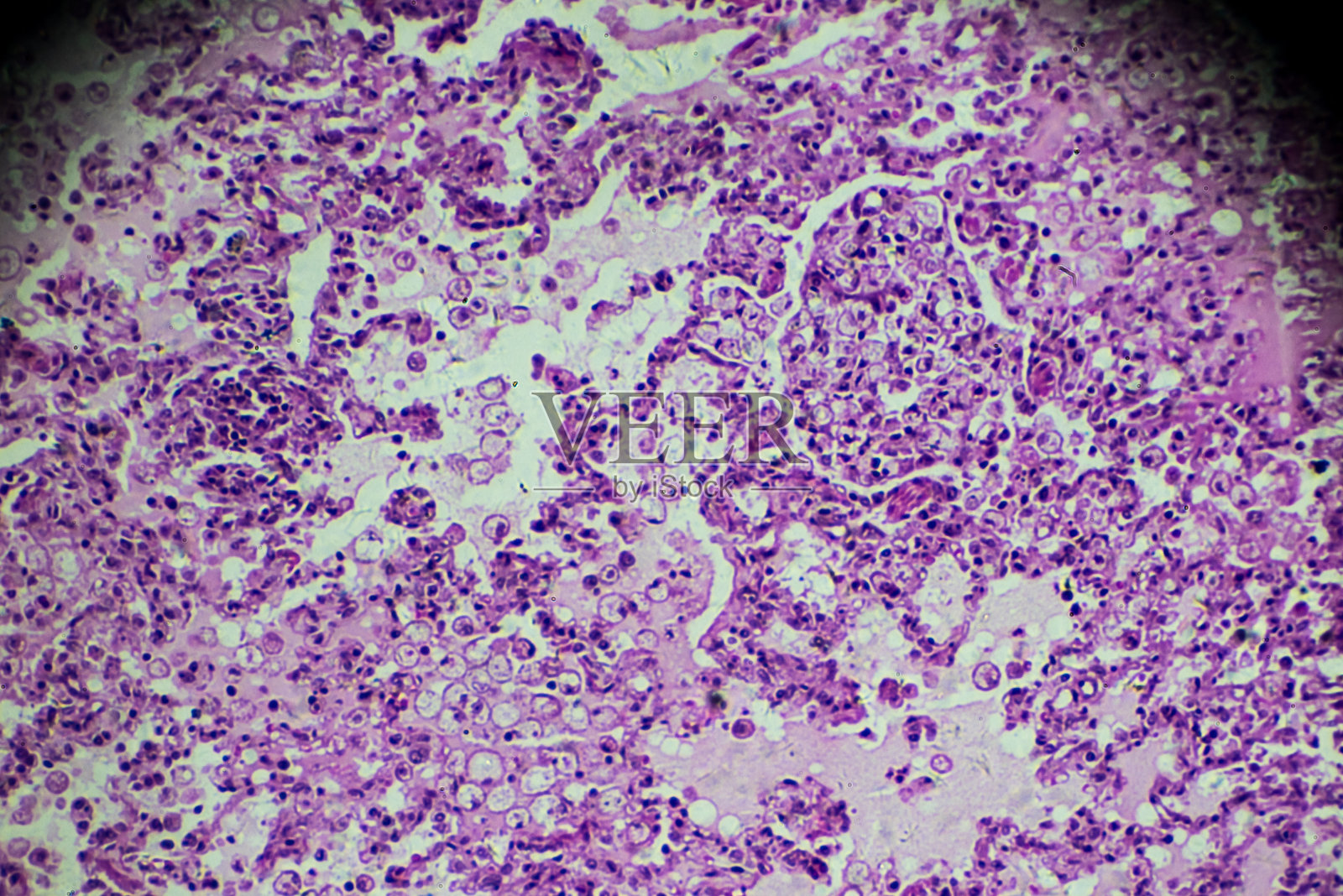 显微镜下小叶性肺炎人体病理生物样本照片摄影图片