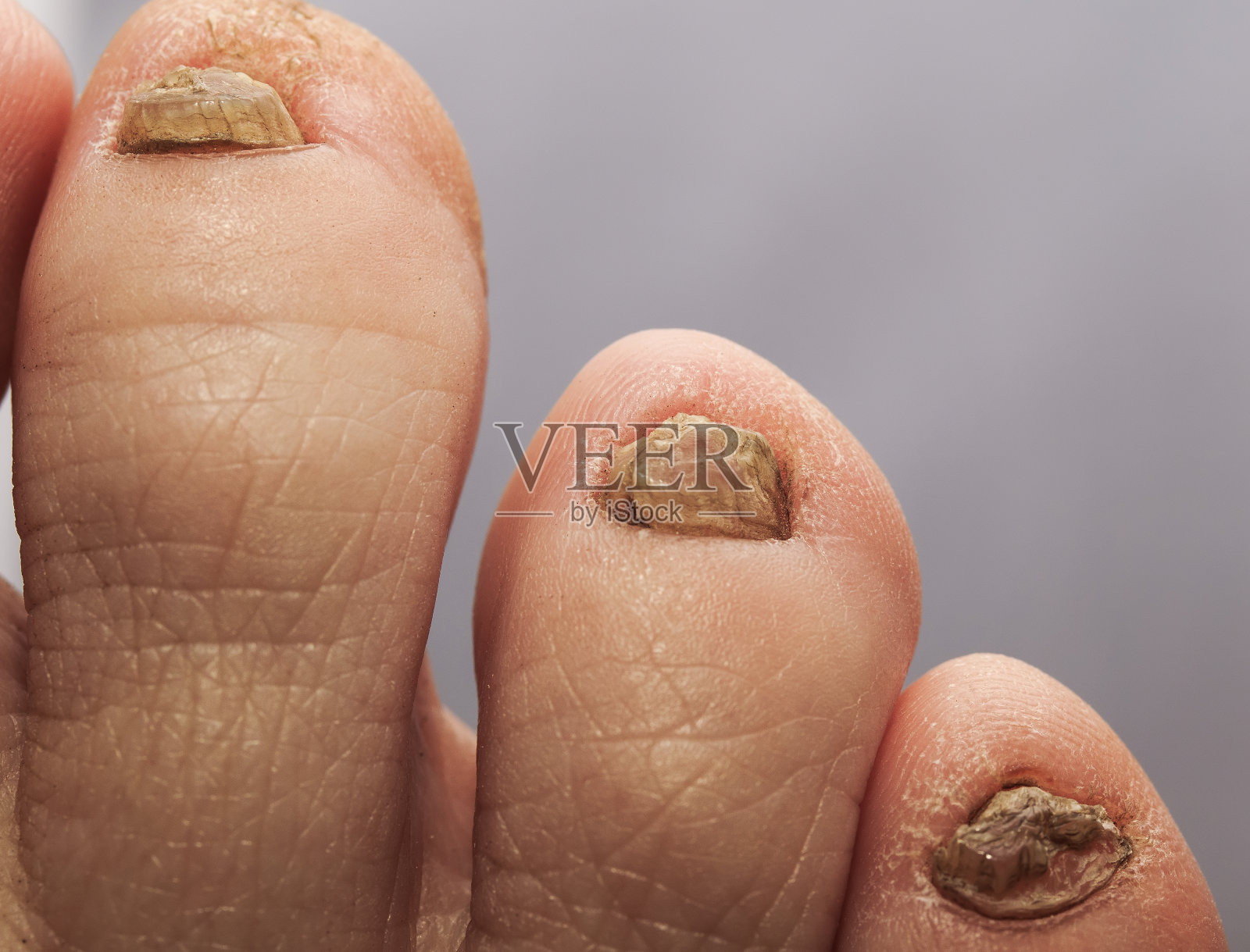 丑陋的脚趾和令人讨厌的指甲受真菌影响照片摄影图片