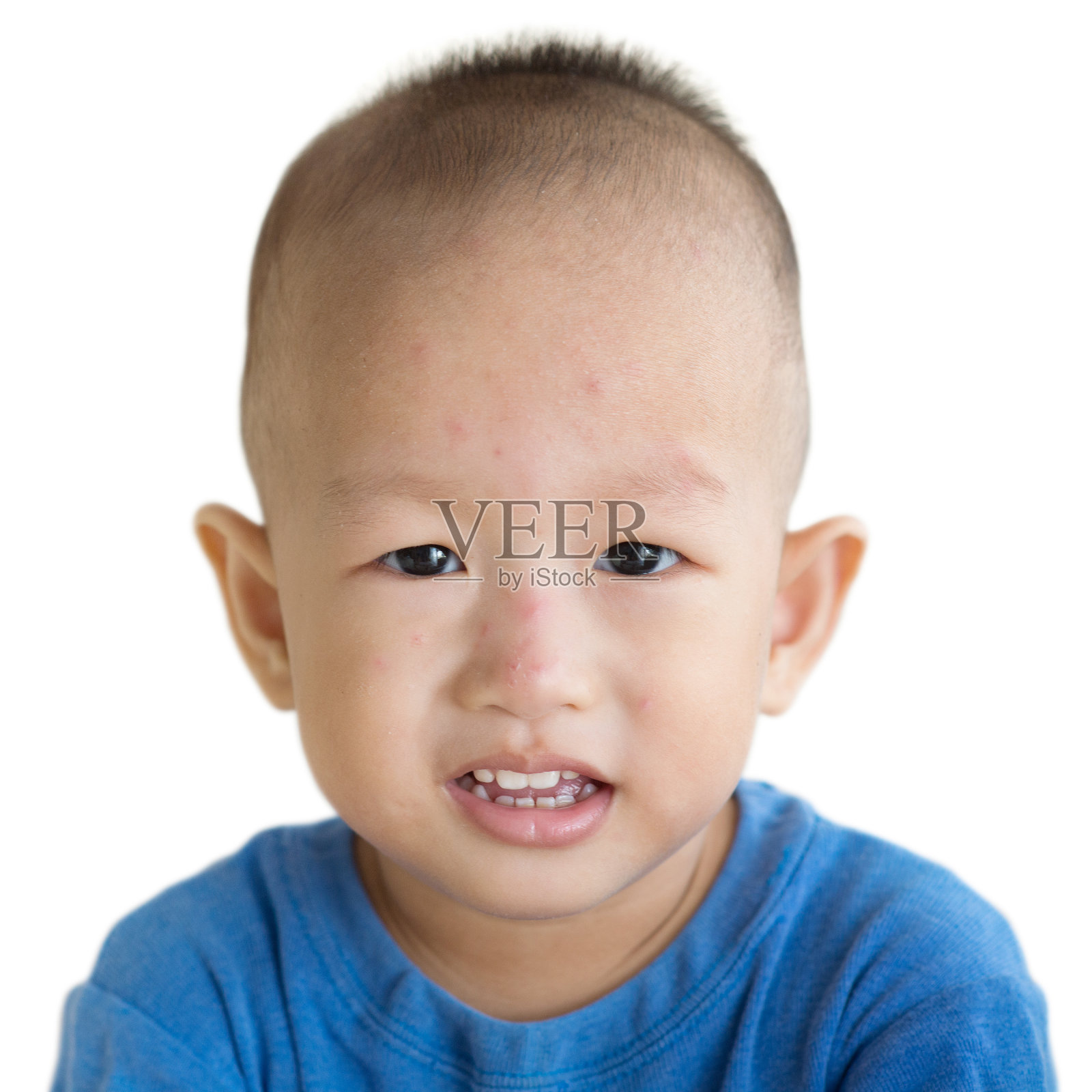 幼童脸上有红疹照片摄影图片
