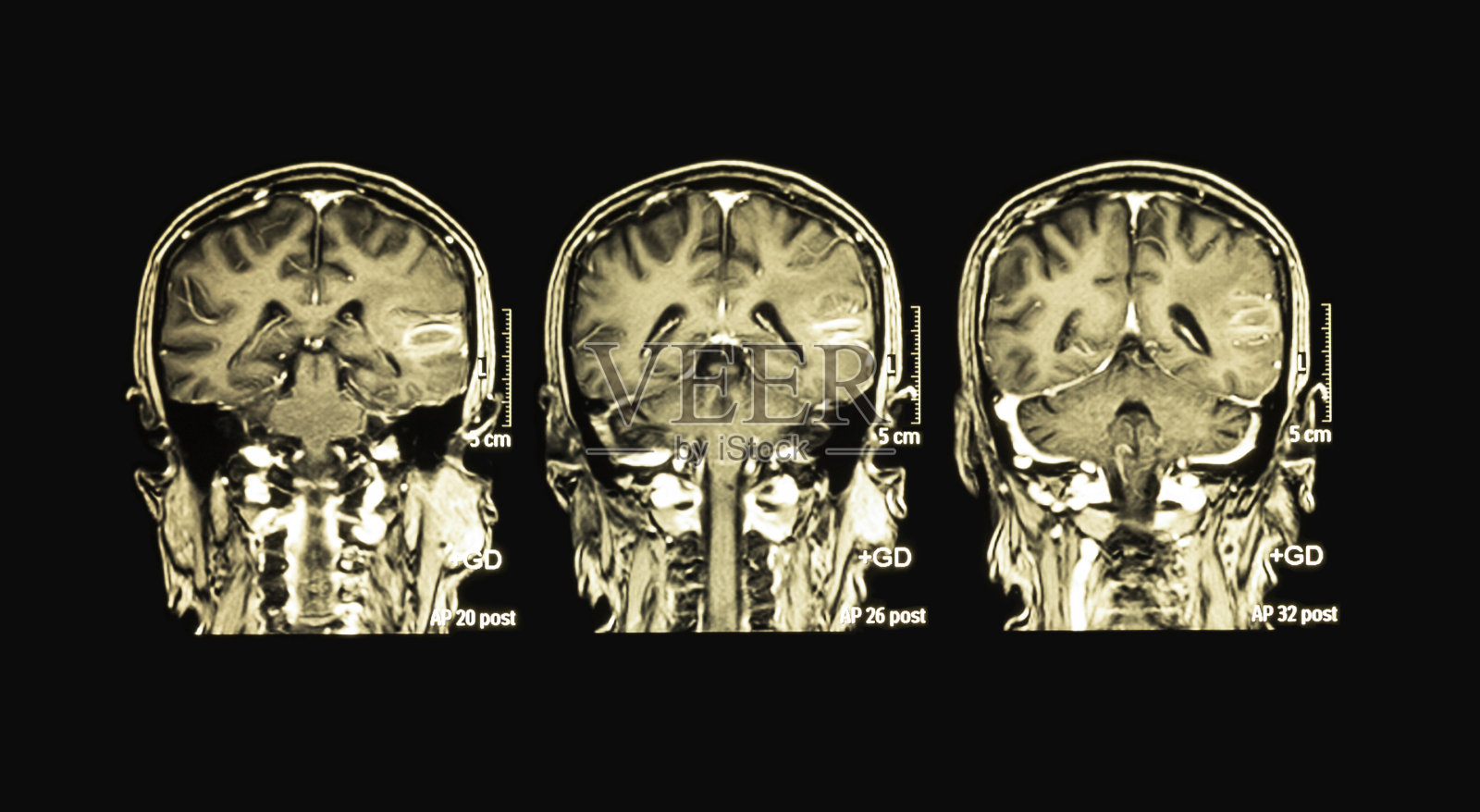 脑mri，左颞叶血肿1例照片摄影图片