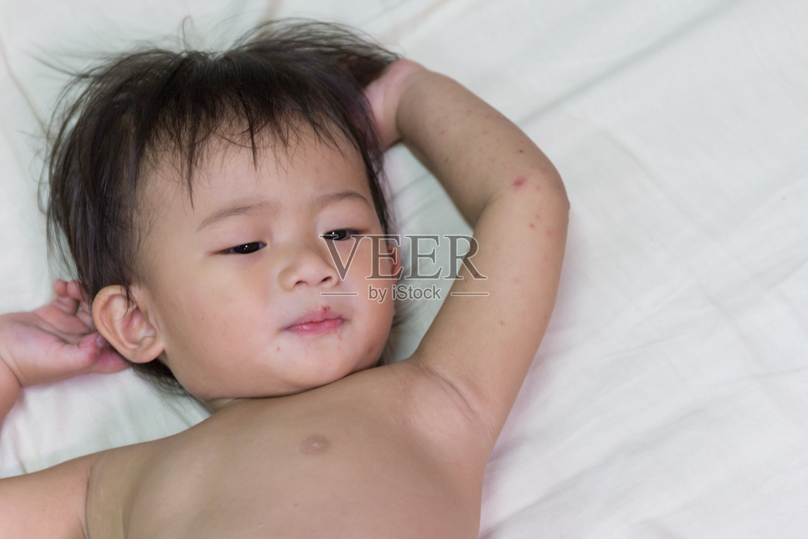 亚洲婴儿感染。照片摄影图片