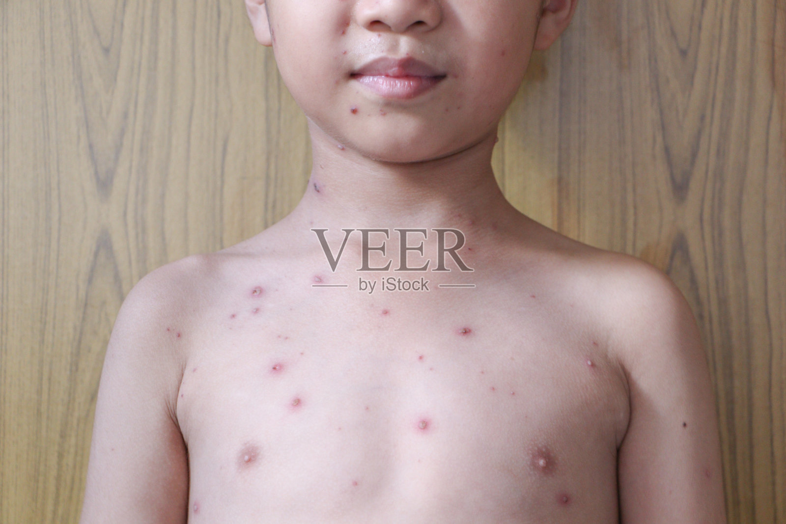 小男孩身上长了水痘。水痘是一种由水痘带状疱疹病毒引起的感染。它最初是起源于面部和躯干的水疱状皮疹照片摄影图片