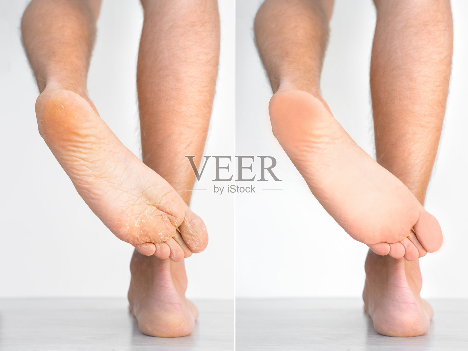 治疗前后皮肤干燥的人的脚。真菌感染或脚癣，皮肤干燥，皮炎，湿疹，牛皮癣或汗脚。卫生保健的概念照片摄影图片