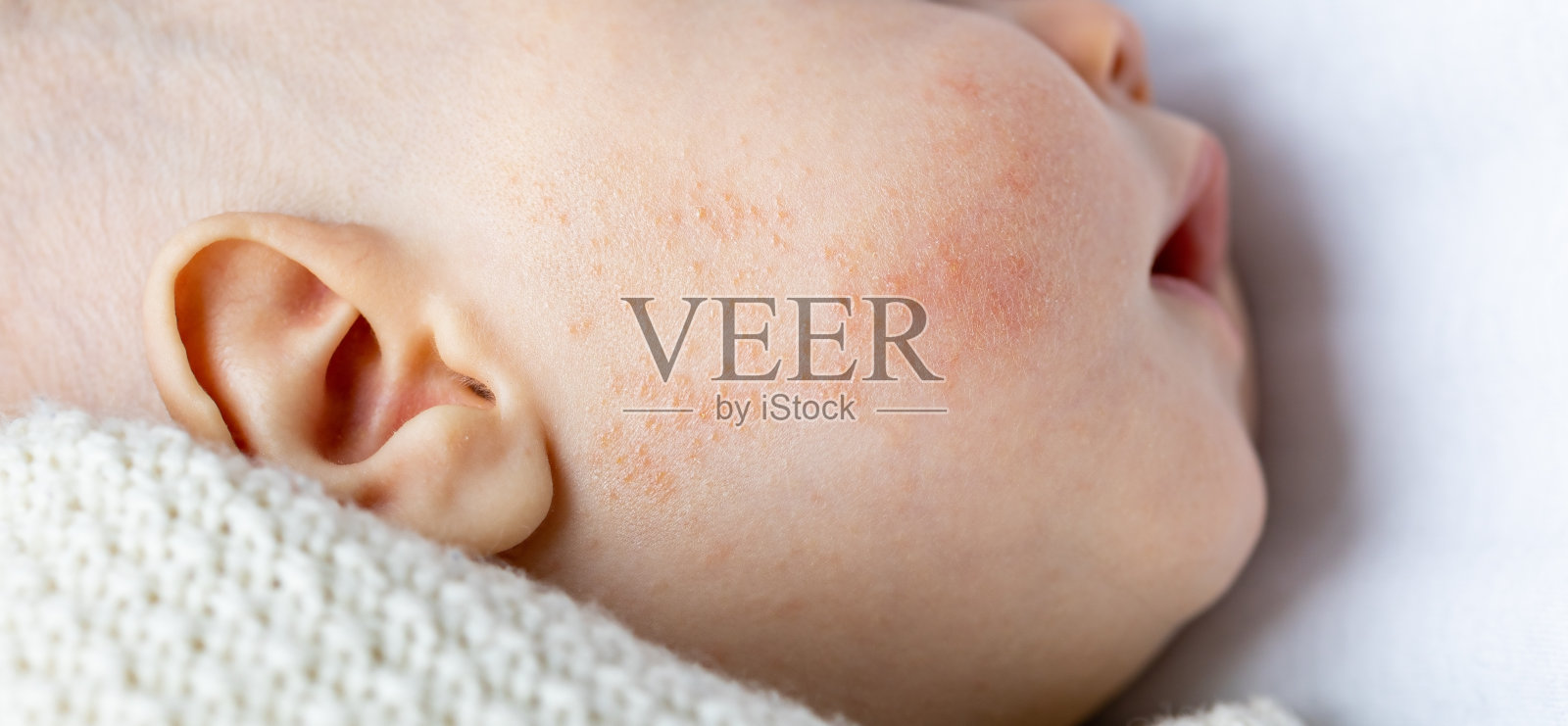 婴儿面部的过敏性皮肤特应性红肿照片摄影图片