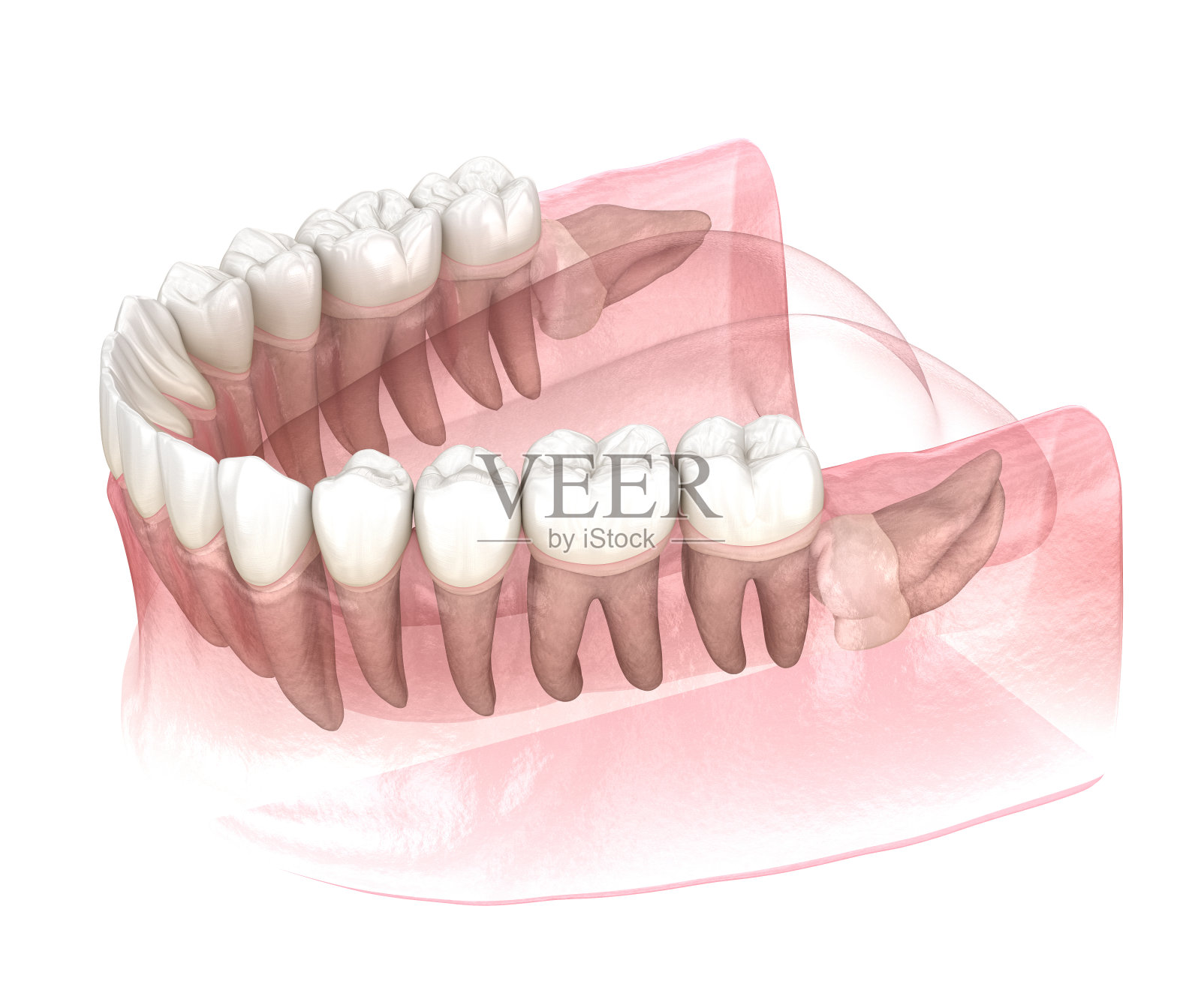 智齿水平嵌顿。医学上准确的牙齿3D插图照片摄影图片