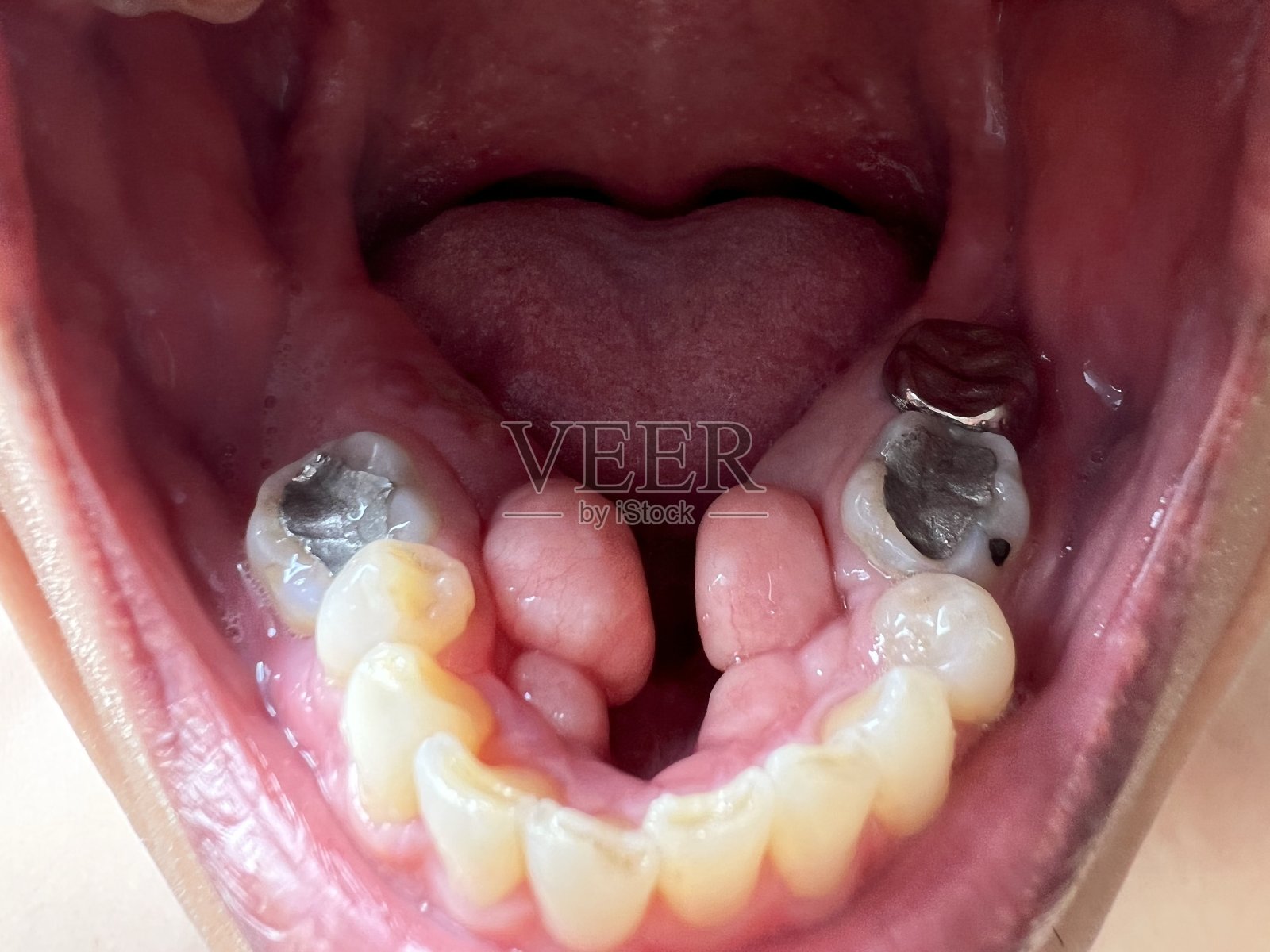 迪拜牙科填充物|补牙|蛀牙和牙齿填充 - New Ivory Dental & Implant Clinic